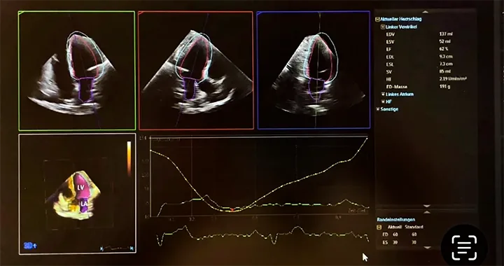Ultraschallfoto einer 3D-Analyse der linksventrikulären Ejektionsfraktion (LVEF)