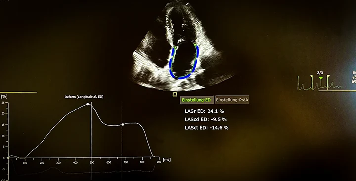 Ultraschallfoto einer Strainanalyse des linken Vorhofs