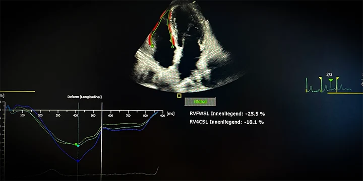 Ultraschallfoto einer Strainanalyse des rechten Ventrikels