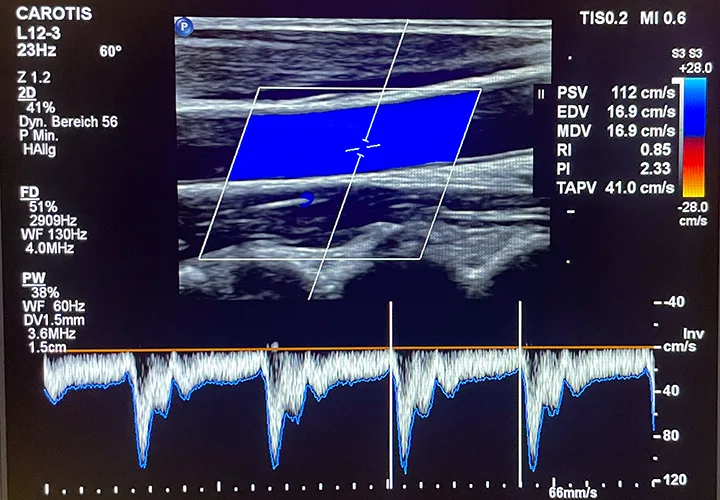 Ultraschallfotos einer Karotisdoppler-Untersuchung