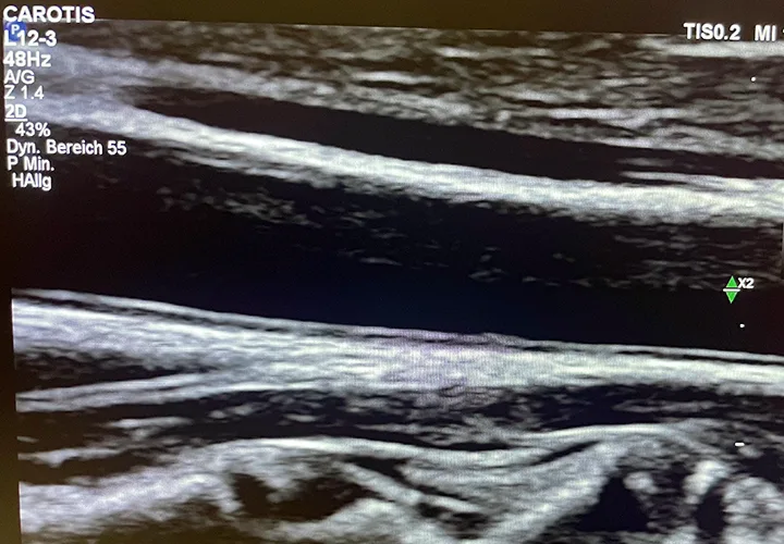 Ultraschallfotos einer Karotisdoppler-Untersuchung