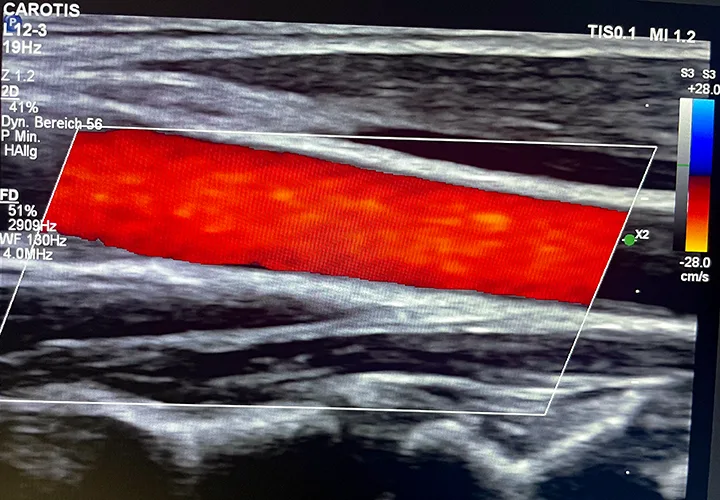Ultraschallfotos einer Karotisdoppler-Untersuchung