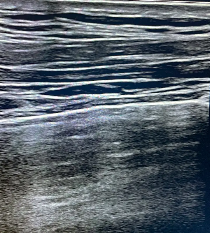 Ultraschallfotos einer Lungensonographie